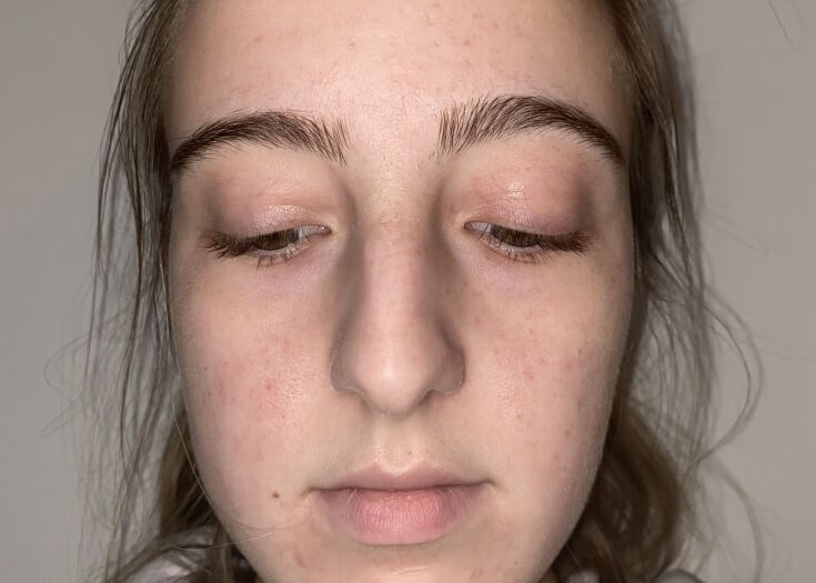 Dr Suzman Rhinoplasty